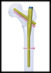 Intramedullary Nail