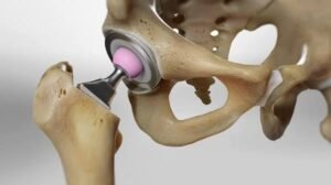 Hip Prosthesis